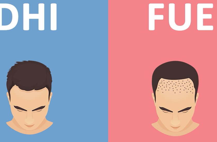 What are the differences between DHI and FUE methods?