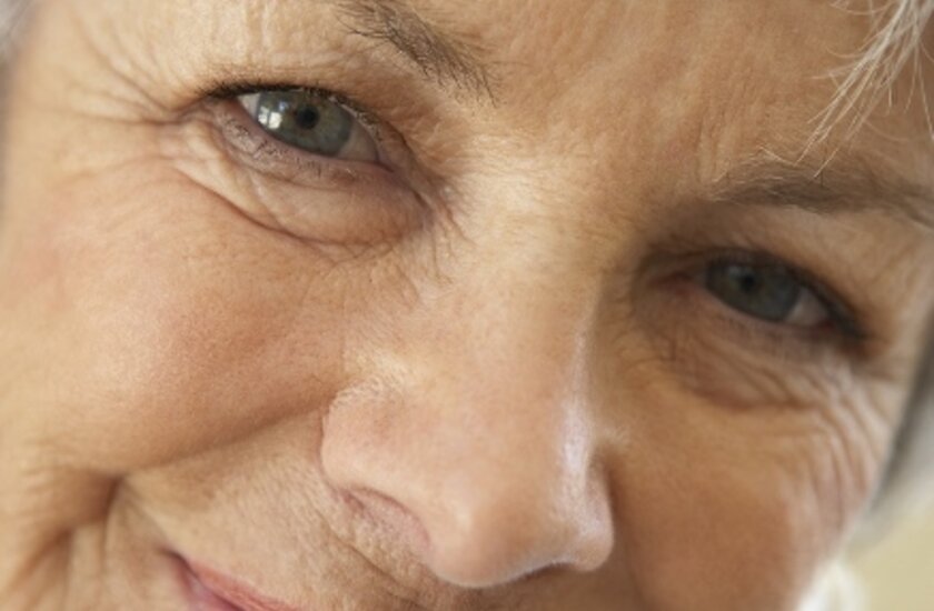 Eyelid correction surgery (blepharoplasty) has a great influence on quality of life 