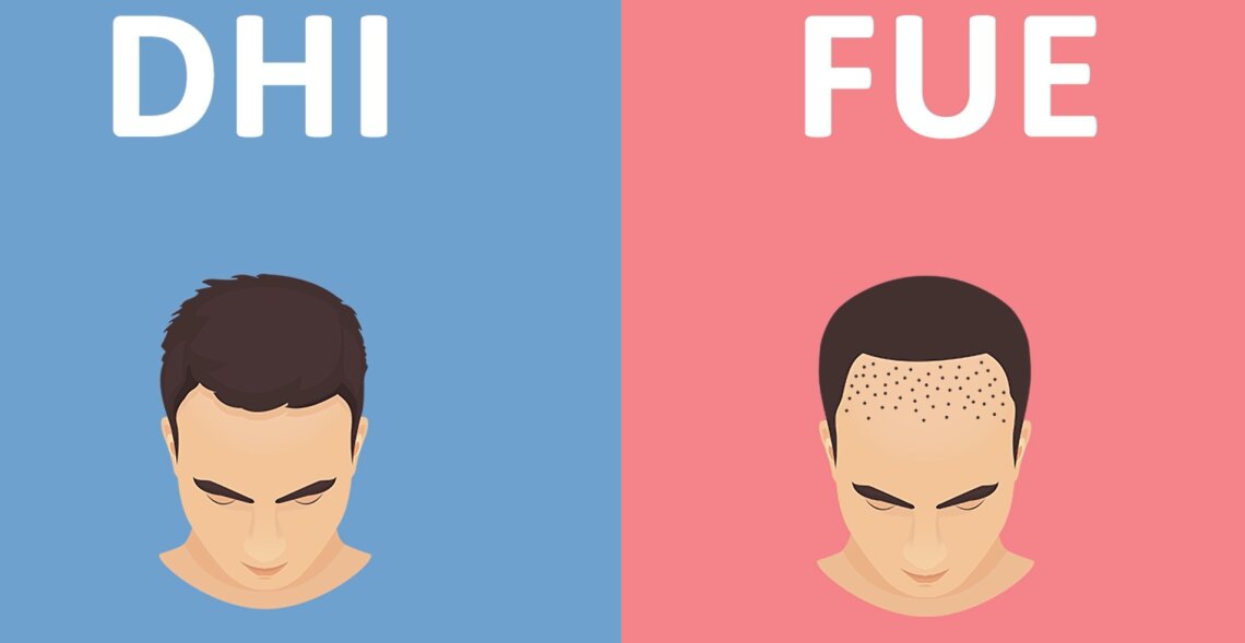 What are the differences between DHI and FUE methods?